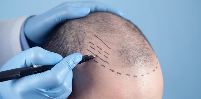 Can a Single Hair Transplant Last a Lifetime? - The Hair Loss Recovery  Program