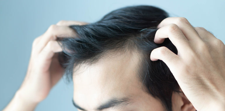What Is The Average Age of Hair Loss & Hair Thinning?