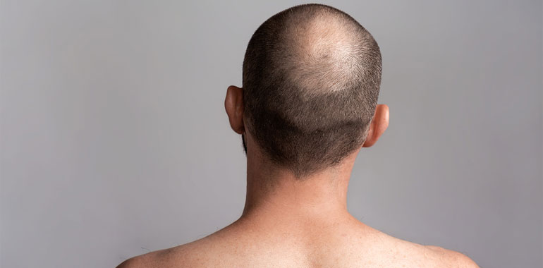 Beard Hair for Hair Transplants? - The Hair Loss Recovery Program