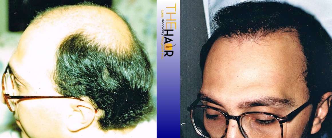 Hair Loss Recovery Before After Photo 1