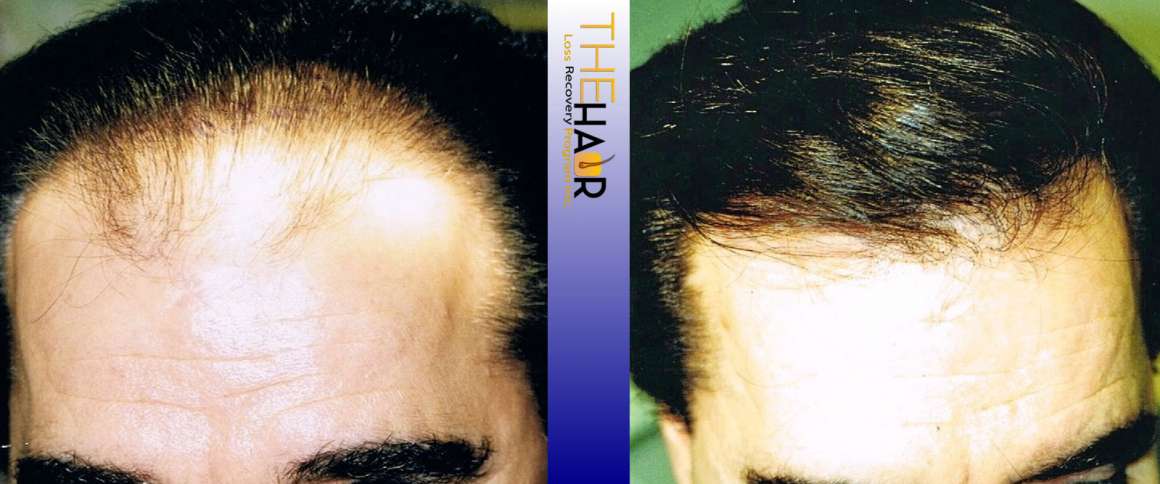 Hair Loss Recovery Before After Photo 3