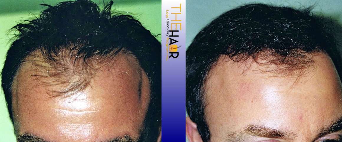 Hair Loss Recovery Before After Photo 4