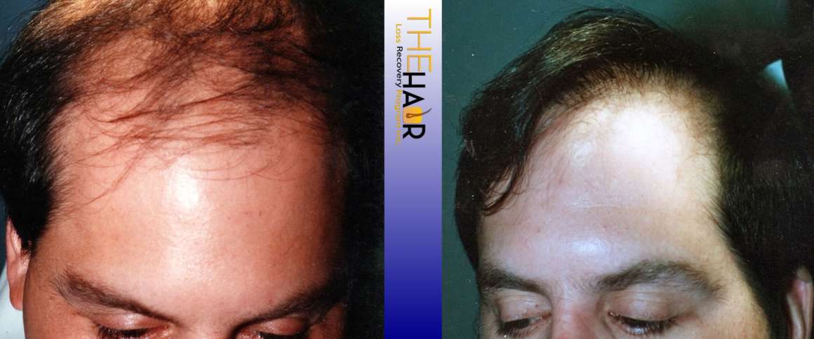 Hair Loss Recovery Before After Photo 8