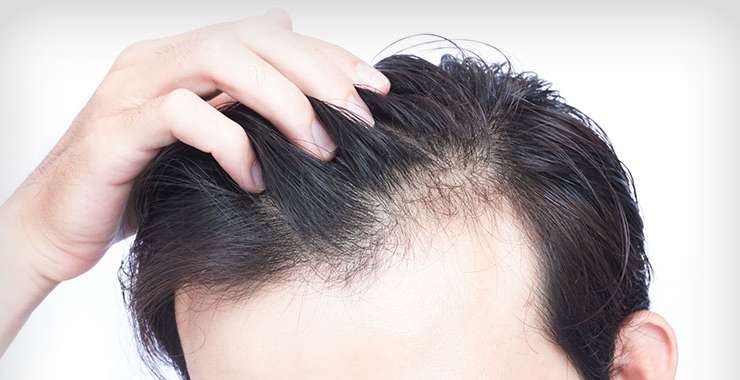 How can I Take Time from my Busy Schedule to Have a Hair Transplant?