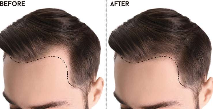 The Importance of Hairline Design in Hair Transplant
