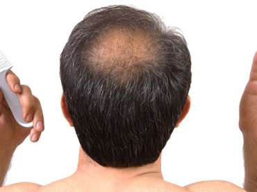 Medical Hair Loss Recovery