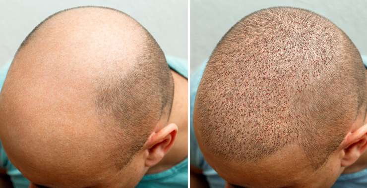 The Stages of Hair Growth After a Hair Transplant