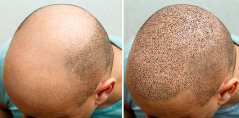 35 year old male, 6 months after 3000 grafts to the hairline and top of the  scalp before and after patient image - Denver Hair Surgery