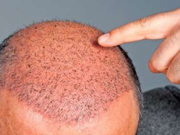 Surgical Hair Loss Recovery
